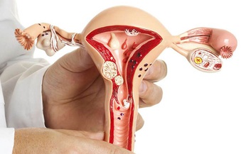 Polyp nội mạc tử cung: Nguyên nhân, nhận biết và các phương pháp điều trị