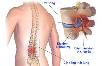 B&#224;i tập ph&#242;ng ngừa v&#224; phục hồi hội chứng đau thắt lưng