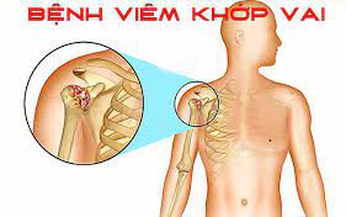 5 b&#224;i tập phục hồi vi&#234;m quanh khớp vai 