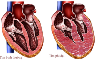 FDA chấp nhận ứng dụng thuốc mới trong bệnh cơ tim ph&#236; đại tắc nghẽn