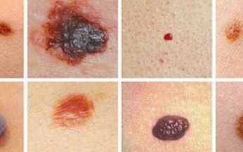 Thuốc mới giúp làm giảm 58% nguy cơ tử vong do ung thư hắc tố ác tính