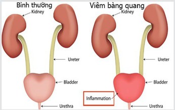 Vi&#234;m b&#224;ng quang v&#224; c&#225;c biến chứng nguy hiểm