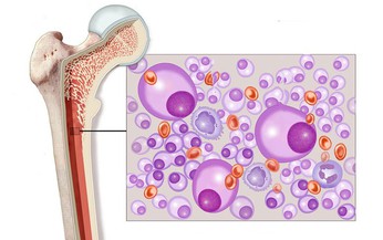 T&#236;m ra phương ph&#225;p điều trị đa u tủy xương kh&#225;ng thuốc