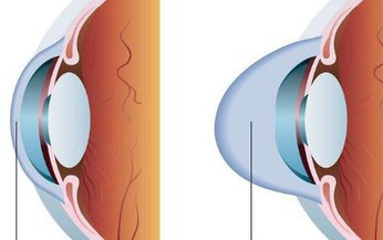 Crosslinking trong phẫu thuật kh&#250;c xạ