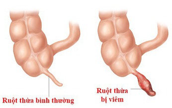 Cần phẫu thuật ruột thừa ngay khi bị vi&#234;m, ai cũng biết nhưng lại kh&#244;ng hiểu