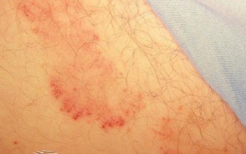 Nhiễm nấm vùng bẹn cần xử trí thế nào để hạn chế tái phát?