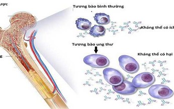 Th&#234;m liệu ph&#225;p điều trị đa u tủy xương t&#225;i ph&#225;t kh&#243; chữa