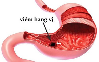 Vi&#234;m - lo&#233;t hang vị dạ d&#224;y hỗ trợ bằng thảo dược được kh&#244;ng?