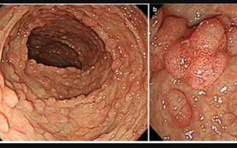 Hội chứng đa polyp gia đ&#236;nh v&#224; mối li&#234;n quan với ung thư đại trực tr&#224;ng