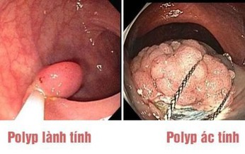 Khi n&#224;o polyp đại&#160;trực&#160;tr&#224;ng th&#224;nh &#225;c t&#237;nh?