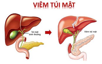 6 huyệt vị hỗ trợ điều trị vi&#234;m t&#250;i mật