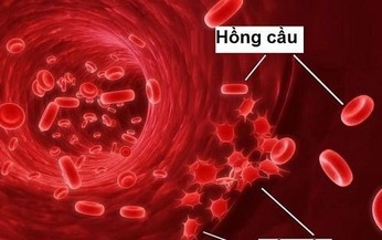 Tổn thương hệ tạo m&#225;u ở người bệnh lupus ban đỏ hệ thống