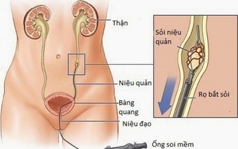 Kỹ thuật t&#225;n sỏi tiết niệu ngo&#224;i cơ thể bằng laser v&#224; những lưu &#253; cho người bệnh