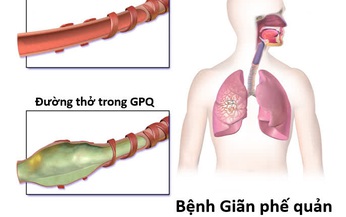 Ho, khạc đờm k&#233;o d&#224;i - Cảnh gi&#225;c với gi&#227;n phế quản