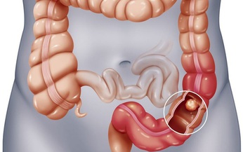 Polyp đại trực tr&#224;ng: Nguy&#234;n nh&#226;n, phương ph&#225;p điều trị v&#224; ph&#242;ng ngừa