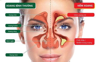 Đề ph&#242;ng vi&#234;m mũi, xoang dị ứng khi thời tiết thất thường