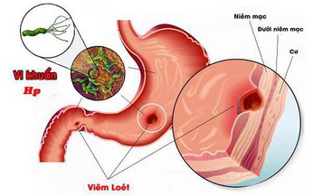 Người bệnh nhiễm vi khuẩn H.Pylori c&#243; th&#234;m phương ph&#225;p chữa trị