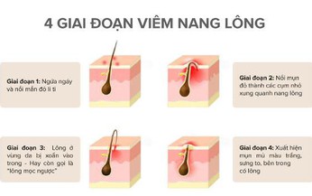 Vi&#234;m nang l&#244;ng chữa thế n&#224;o?