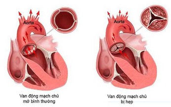 Hẹp van động mạch chủ v&#224; c&#225;c lựa chọn điều trị