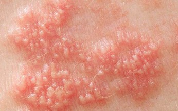 Nhận biết v&#224; ph&#242;ng ngừa Herpes sinh dục