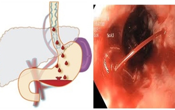 C&#225;ch ph&#225;t hiện sớm v&#224; dự ph&#242;ng gi&#227;n tĩnh mạch thực quản nguy hiểm ở bệnh nh&#226;n xơ gan 