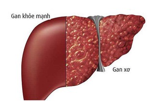 B&#236;nh v&#244;i, vị thuốc hỗ trợ điều trị xơ gan