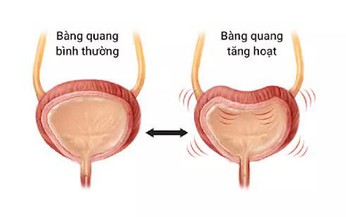 B&#224;ng quang tăng hoạt: chứng bệnh kh&#244;ng chỉ g&#226;y phiền to&#225;i