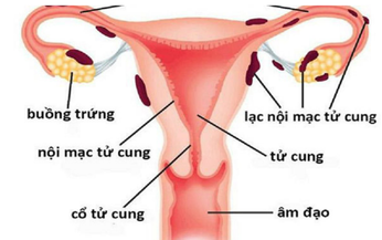 Thuốc giảm đau do lạc nội mạc tử cung ở phụ nữ tiền m&#227;n kinh