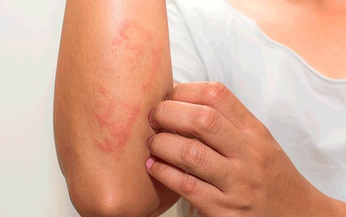 Viêm da cơ - Viêm đa cơ: Nguyên nhân, triệu chứng và cách phòng tránh