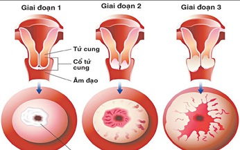 Nhận biết sớm ung thư cổ tử cung