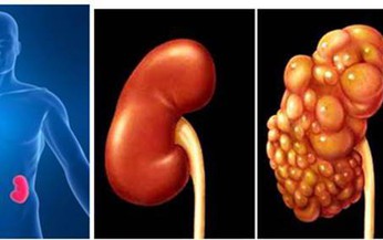 Nang thận, ai dễ mắc phải căn bệnh này?