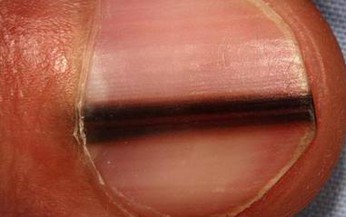 Dấu hiệu nhận biết ung thư tế bào hắc tố ở móng tay