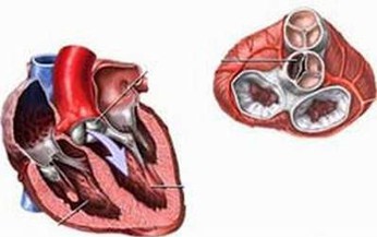 Bệnh thấp tim (thấp khớp cấp) d&#249;ng thuốc g&#236; để chữa?