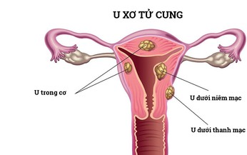 Bụng to bất thường l&#224; biểu hiện của bệnh g&#236;, khi n&#224;o n&#234;n đi kh&#225;m?