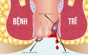 Bấm huyệt hỗ trợ điều trị bệnh trĩ