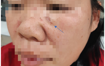 Ung thư biểu mô tế bào đáy tái phát và phương pháp chữa hiệu quả