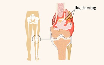 Ung thư xương: B&#225;c sĩ cảnh b&#225;o những dấu hiệu cần lưu &#253;