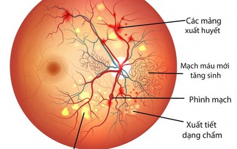 Điều trị biến chứng v&#245;ng mạc do đ&#225;i th&#225;o đường