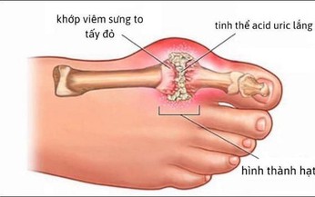 Ph&#242;ng bệnh gout t&#225;i ph&#225;t bằng m&#243;n ăn b&#224;i thuốc đơn giản tại nh&#224;