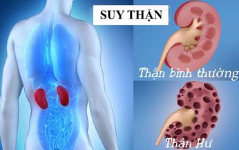 Suy thận do uống cỏ mực, dấu hiệu cảnh b&#225;o căn bệnh n&#224;y