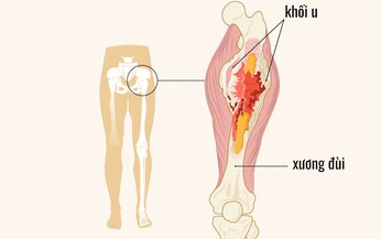 Dấu hiệu cảnh b&#225;o ung thư xương ở trẻ cha mẹ cần lưu &#253;