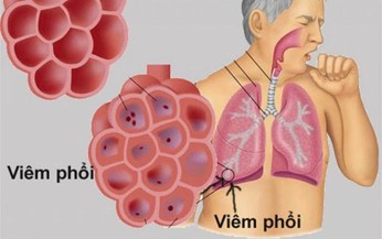Mẹo kiểm soát bệnh viêm phổi mùa đông