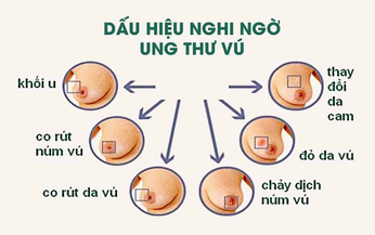 10 biện ph&#225;p gi&#250;p giảm nguy cơ ung thư v&#250;