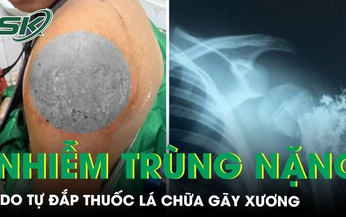 Nhiễm tr&#249;ng nặng do đắp l&#225; chữa g&#227;y xương