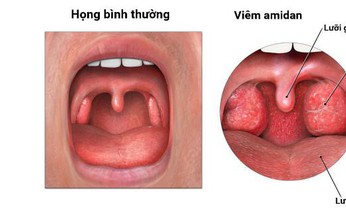 Xoa b&#243;p huyệt vị hỗ trợ điều trị vi&#234;m họng