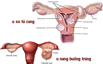 U xơ tử cung, u nang buồng trứng c&#243; nguy hiểm?