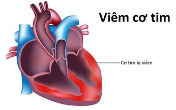 Nguy&#234;n nh&#226;n vi&#234;m cơ tim v&#224; c&#225;c triệu chứng b&#225;o hiệu cần biết