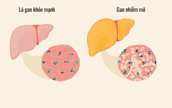 Gan nhiễm mỡ l&#224; g&#236;? Biểu hiện gan nhiễm mỡ