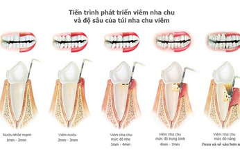 C&#225;c phương ph&#225;p điều trị vi&#234;m nha chu