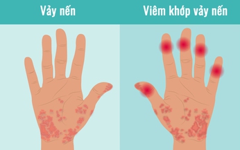 Bị vi&#234;m khớp vảy nến n&#234;n l&#224;m g&#236;?